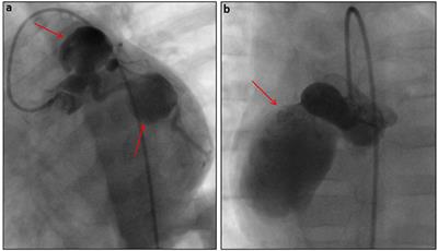 COVID-19, State of the Adult and Pediatric Heart: From Myocardial Injury to Cardiac Effect of Potential Therapeutic Intervention